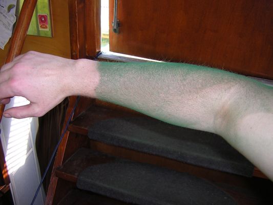 Melissa's green arm